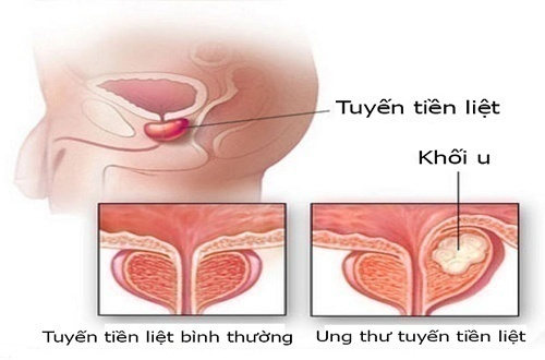 Xét nghiệm nào được dùng để phát hiện ung thư tiền liệt tuyến? - ảnh 1