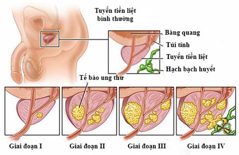 Các triệu chứng ung thư tuyến tiền liệt giai đoạn cuối - ảnh 3