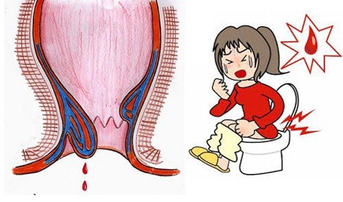 Sa trực tràng và trĩ có giống nhau không? - ảnh 1