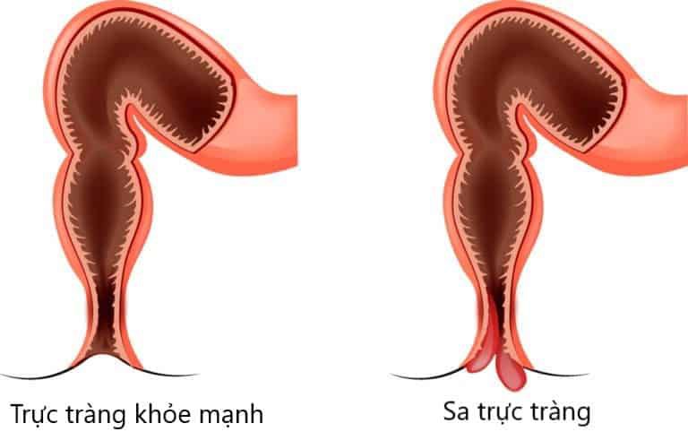 Sa trực tràng là bệnh gì? Nguyên nhân và dấu hiệu nhận biết - ảnh 2