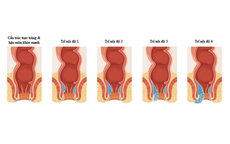 Sa trực tràng là bệnh gì? Nguyên nhân và dấu hiệu nhận biết - ảnh 1