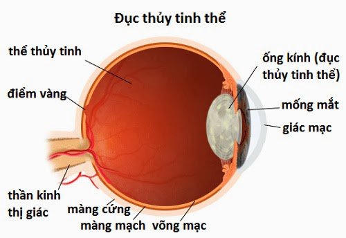 Đục thủy tinh thể: Nên mổ sớm, đừng chần chừ - ảnh 1