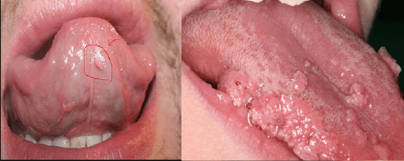 Sùi mào gà là bệnh gì và có tự khỏi được không? - ảnh 1