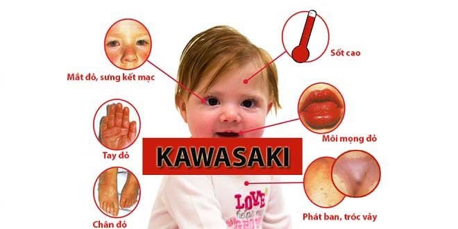 Kawasaki ở trẻ em là bệnh gì? Có nguy hiểm không? - ảnh 1