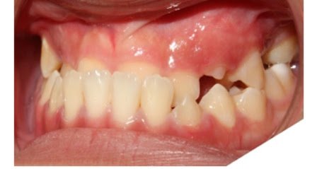 Chỉnh sửa xương hàm để chữa dứt điểm lệch khớp cắn - ảnh 1