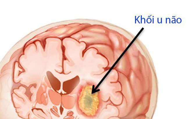 Triệu chứng bệnh u não và cách điều trị - ảnh 1