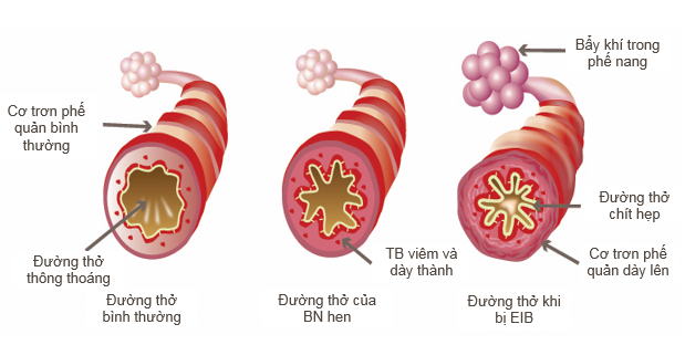 Co thắt phế quản do gắng sức - ảnh 4