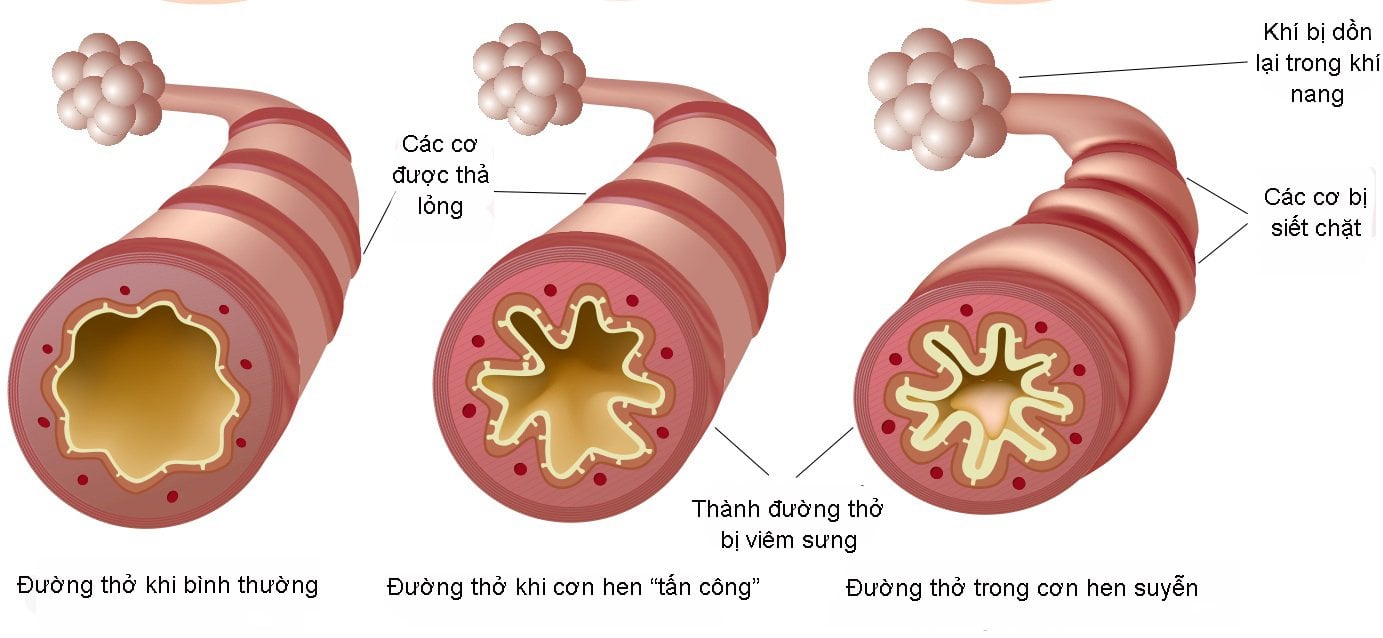 Co thắt phế quản do gắng sức - ảnh 1