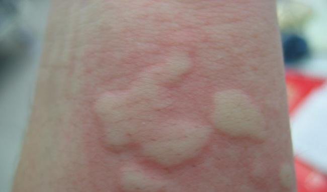 Dị ứng thời tiết: Nguyên nhân, dấu hiệu nhận biết và cách điều trị - ảnh 1
