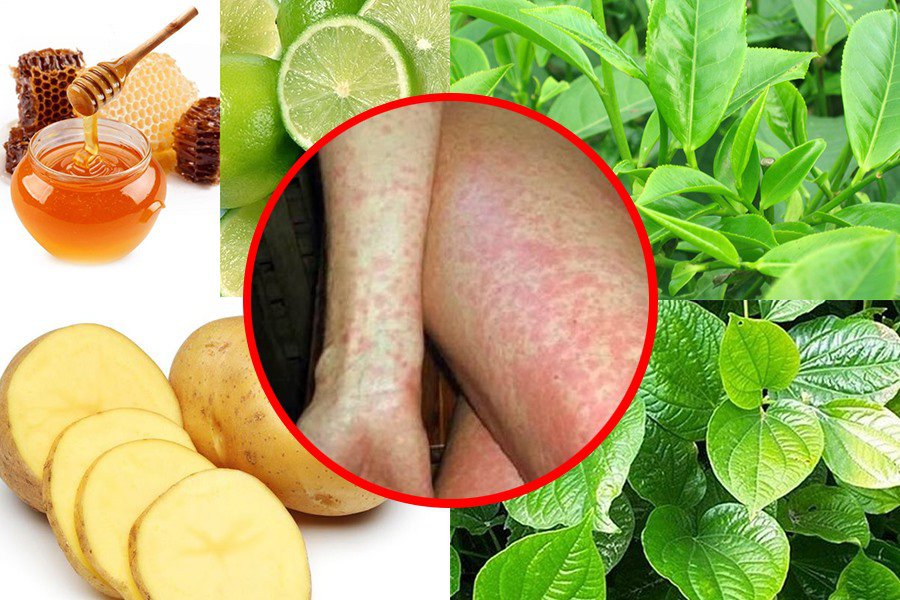 Dị ứng thời tiết: Nguyên nhân, dấu hiệu nhận biết và cách điều trị - ảnh 2