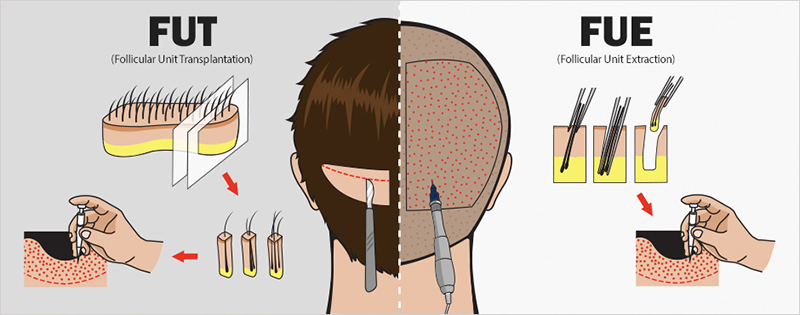 Cấy tóc: Những điều cần biết - ảnh 2