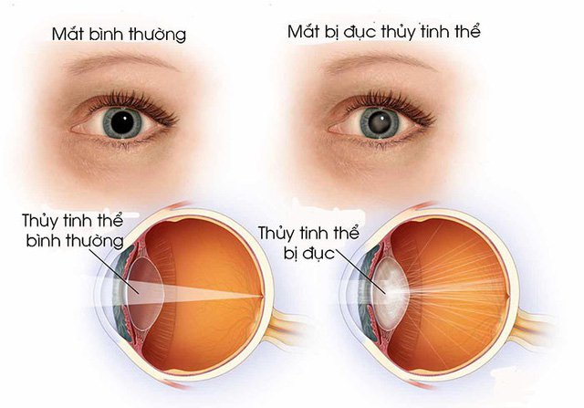 Bệnh đục thủy tinh thể có thể gây mù lòa - Cần khám những gì để phát hiện bệnh?