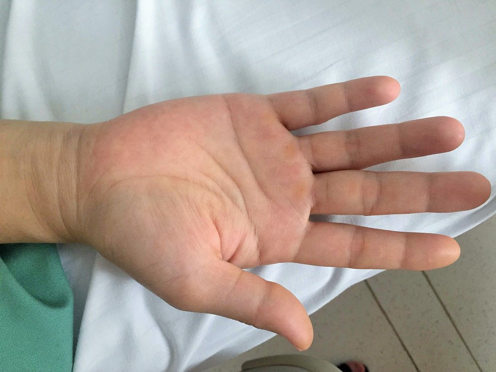Nội soi cắt chuỗi hạch giao cảm - ảnh 2
