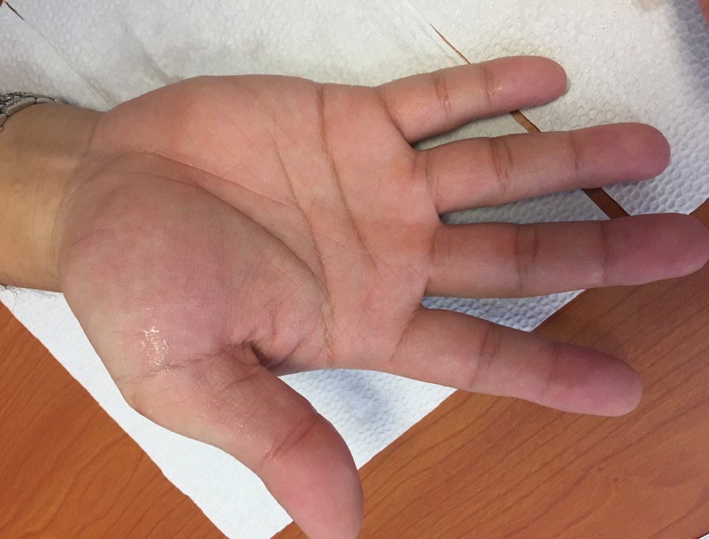 Nội soi cắt chuỗi hạch giao cảm - ảnh 1