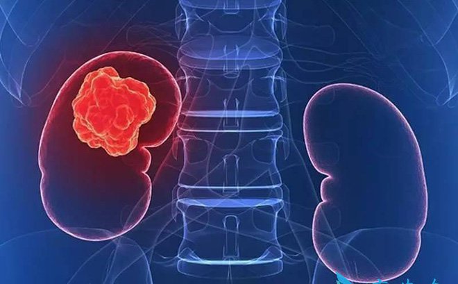 Những dấu hiệu liên quan đến ung thư thận mọi người cần biết - ảnh 2