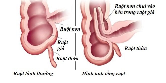 Lồng ruột trẻ em là gì/ Nguyên nhân và Cách điều trị - ảnh 1