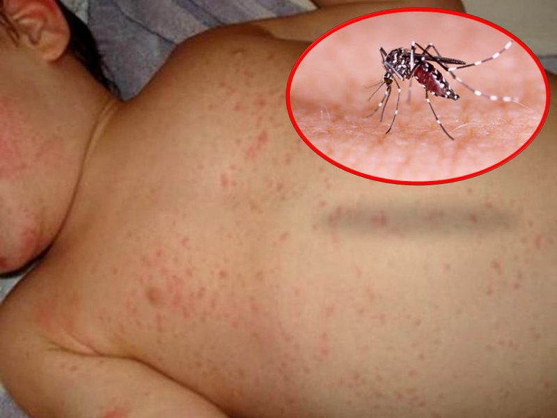 Ý nghĩa chỉ số IgM/IgG trong xét nghiệm chẩn đoán sốt xuất huyết - ảnh 2