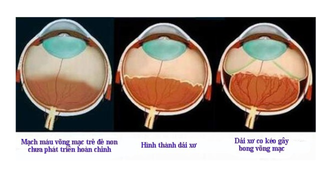 Bệnh võng mạc trẻ đẻ non - ảnh 1