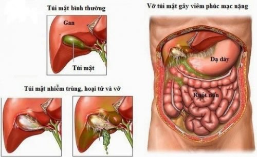 Biến chứng nguy hiểm của viêm ruột thừa cấp - ảnh 1