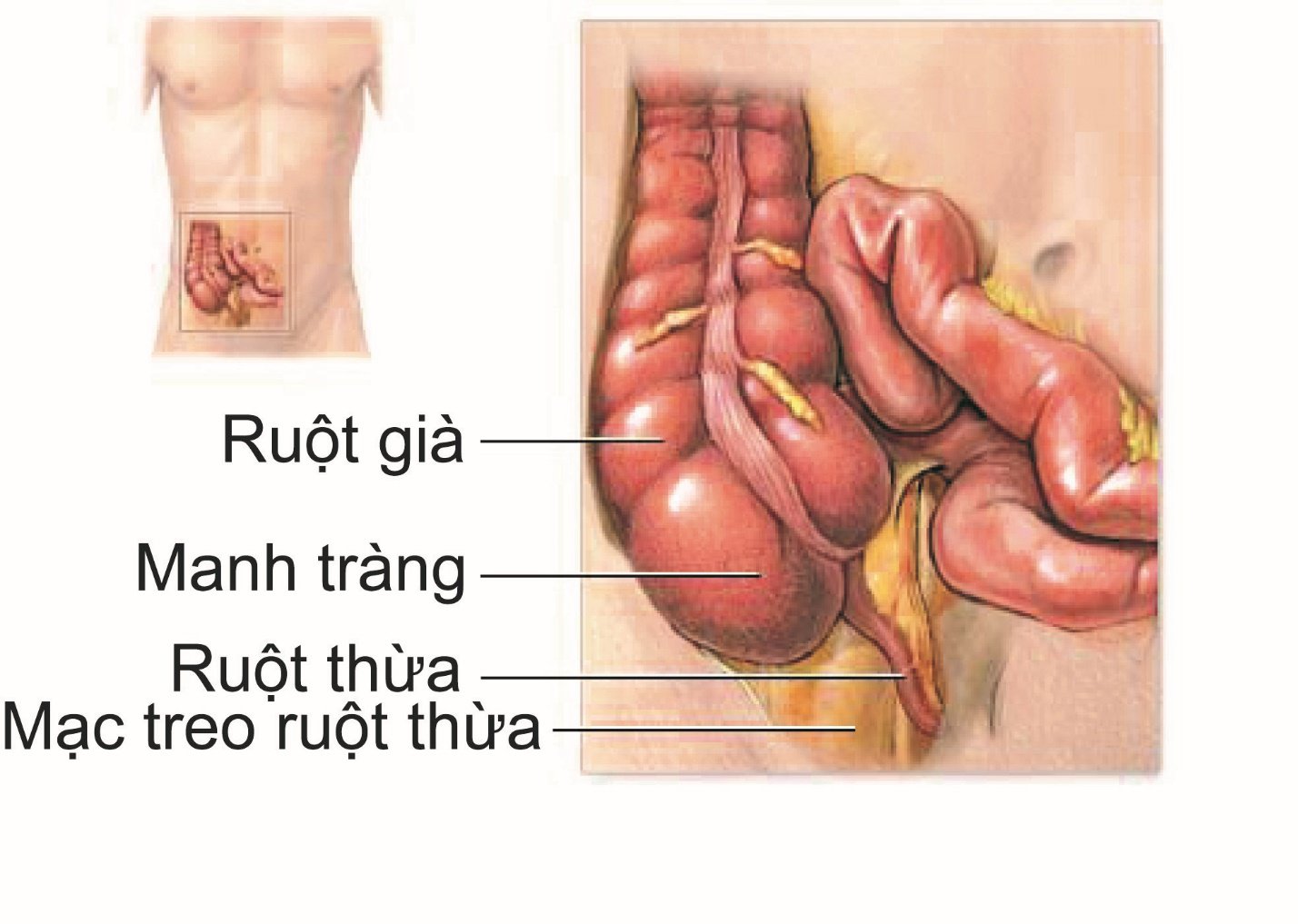Viêm ruột thừa diễn biến thế nào và kéo dài bao lâu? - ảnh 1