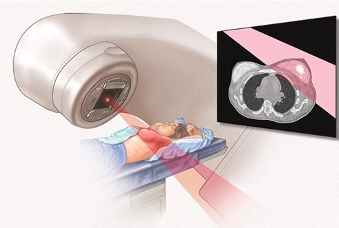 Cẩm nang hỗ trợ bệnh nhân xạ trị vùng đầu cổ - ảnh 1