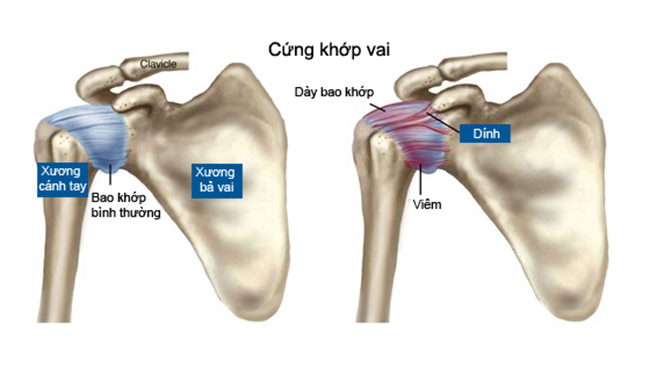 Bệnh lý khớp vai thường gặp - ảnh 3