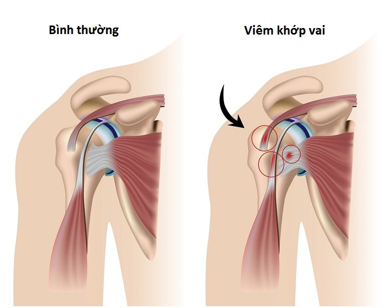 Bệnh lý khớp vai thường gặp - ảnh 5