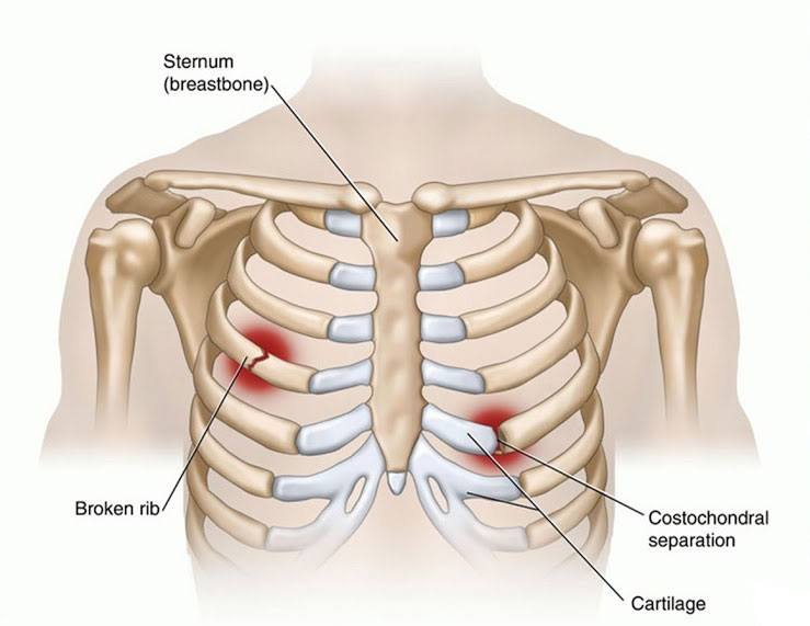 Gãy xương có biến chứng nguy hiểm nếu không điều trị sớm - ảnh 2