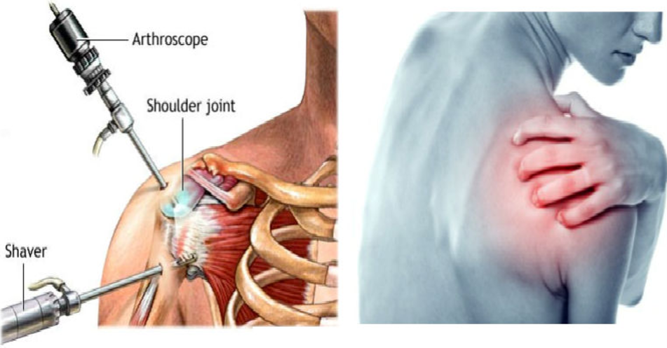 Phương pháp Nội soi Chẩn đoán các bệnh về khớp vai - ảnh 1