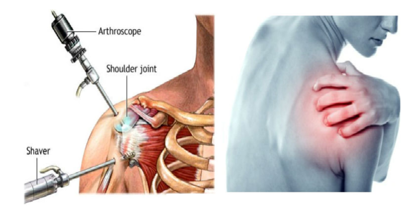 Ưu điểm của phẫu thuật nội soi khớp vai - ảnh 1