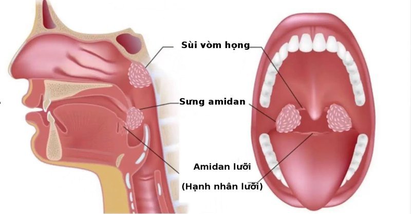 Cắt amidan ở người lớn trên 45 tuổi cần lưu ý những gì? - ảnh 1