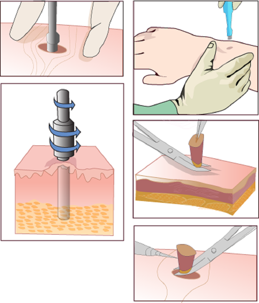 Sinh thiết da trong chẩn đoán ung thư da - ảnh 2