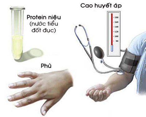 Xét nghiệm yếu tố tân tạo mạch máu PLGF trong 3 tháng Phát hiện sớm tiền sản giật - ảnh 1