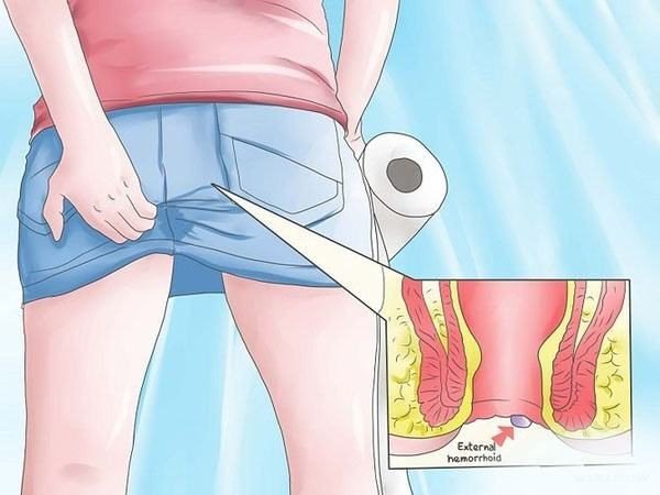 Bệnh trĩ độ 1 có cần phẫu thuật? - ảnh 1