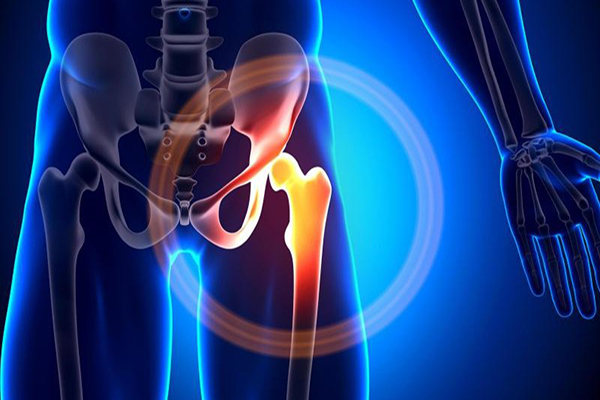 Biến chứng có thể gặp sau thay khớp háng nhân tạo - ảnh 2