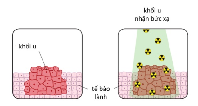 Xạ trị ung thư diễn ra như thế nào? - ảnh 1