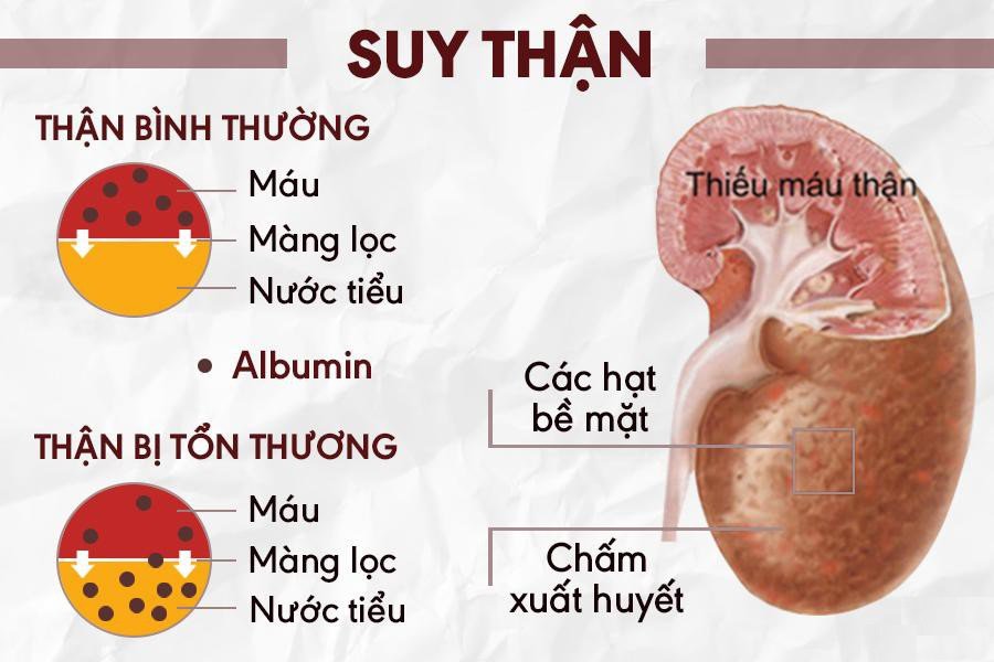 Suy thận mạn có mấy giai đoạn và Các phương pháp điều trị hiệu quả - ảnh 2
