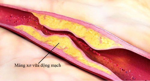 Cao huyết áp là bệnh gì? điều trị thế nào? - ảnh 1