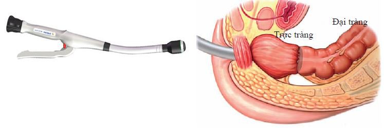 Mổ nội soi cắt đại tràng: Khi nào cần thực hiện?