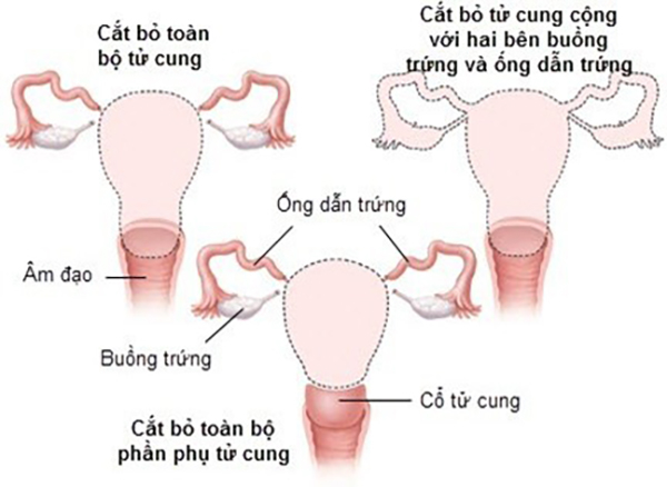 Nguy cơ ung thư buồng trứng sau phẫu thuật cắt tử cung - ảnh 1