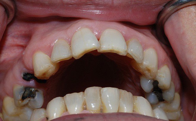 Ăn nhiều đường làm tăng nguy cơ mắc các bệnh tim mạch, mãn tính - ảnh 2