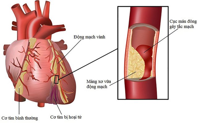Hẹp mạch vành: Khi nào dùng thuốc, khi nào đặt stent, khi nào phải mổ?