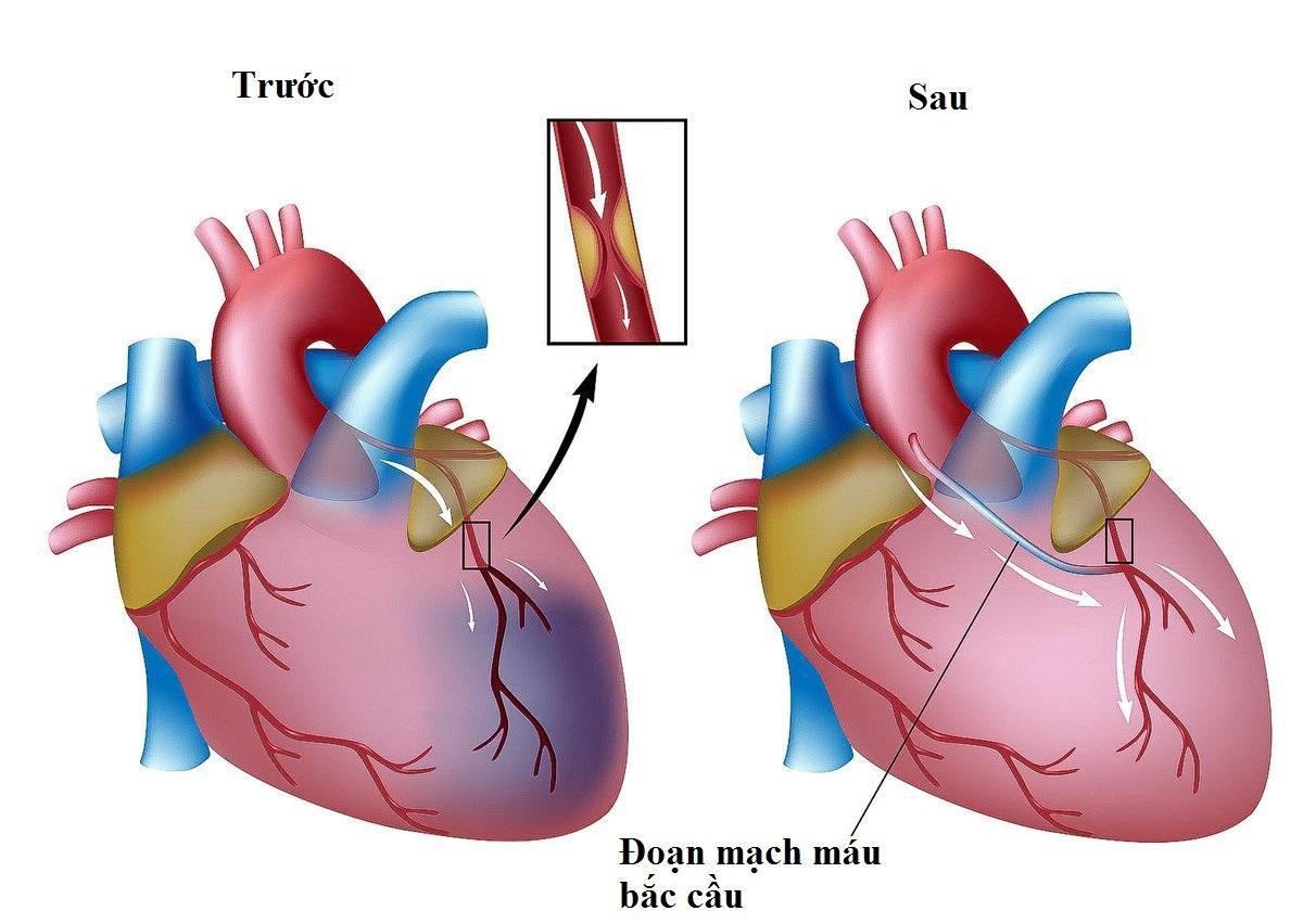 Hẹp mạch vành: Khi nào dùng thuốc, khi nào đặt stent, khi nào phải mổ?