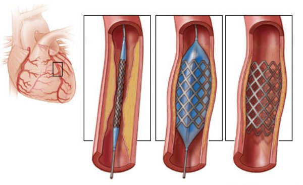 Nong mạch vành và đặt stent: Chỉ định, quy trình thực hiện, biến chứng có thể xảy ra
