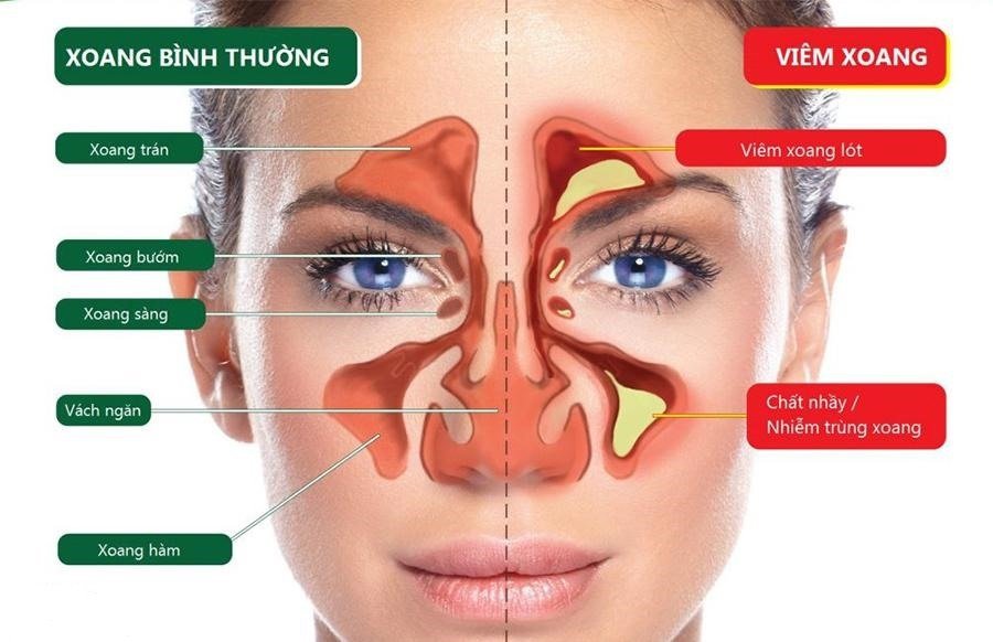 Đau nửa đầu là bệnh gì?, dễ nhầm lẫn với bệnh gì? - ảnh 2