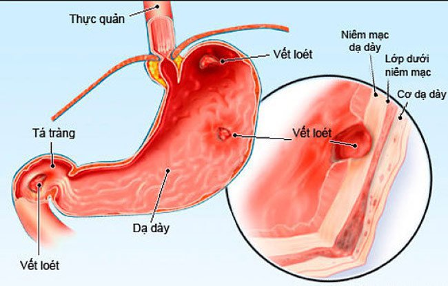 Chữa loét dạ dày tá tràng bằng thuốc không đỡ, phải làm thế nào? - ảnh 2