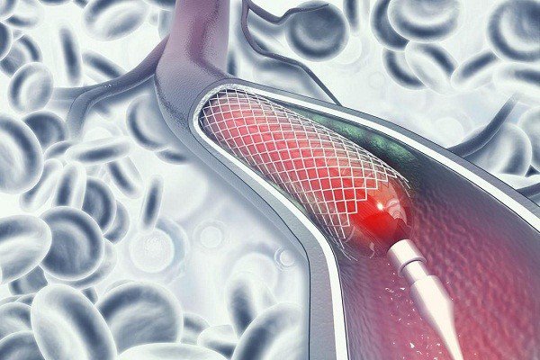 Đặt stent mạch vành được tiến hành như thế nào?, Khi nào cần can thiệp? - ảnh 1