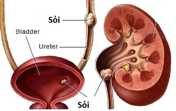 Sỏi đường tiết niệu là bệnh gì? Các phương pháp điều trị - ảnh 1