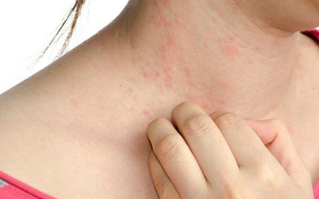 Sốt xuất huyết có các cấp độ nào? và dấu hiệu nhận biết - ảnh 2