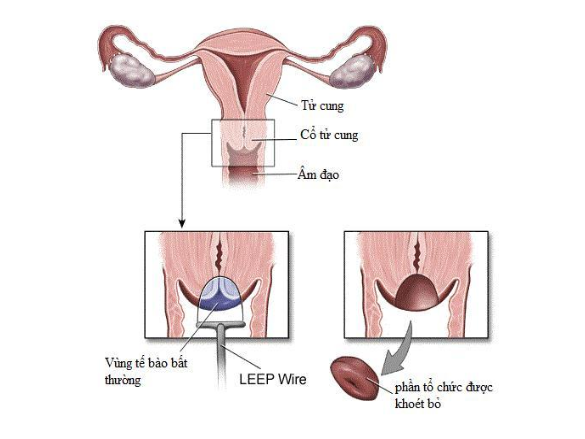 Khoét chóp cổ tử cung bằng vòng điện (LEEP) - Những điều cần biết - ảnh 2
